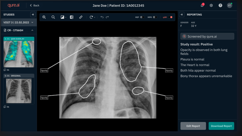 AI analyzing and commenting on a patient x-ray