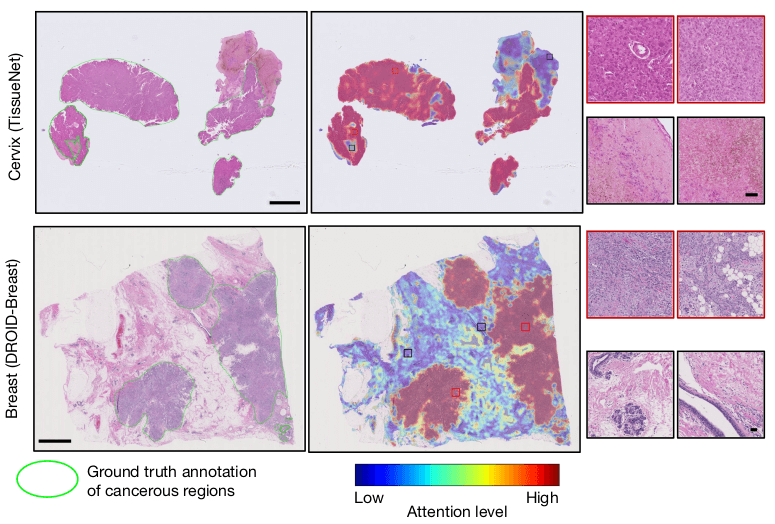 CHIEF analyzing cancer cells with AI